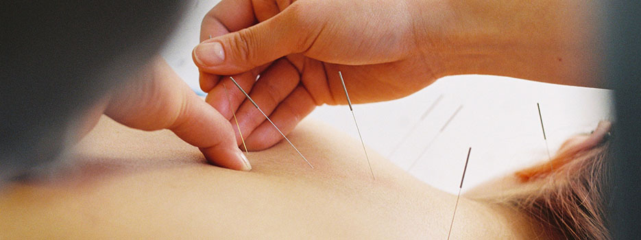 Acupuncturist placing needles in woman's back to help alleviate pain.